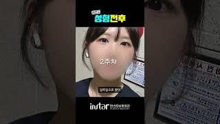 쌍수(쌍꺼풀 수술) 없이 예뻐지는 법이 있다면 ? #무쌍눈매교정 #무쌍성형 #무쌍수술 #성형외과 #강남성형외과 #눈매교정 #눈매교정 #절개눈매교정 #인스타성형외과