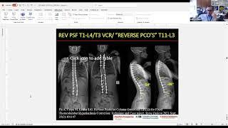 What Is the Target for Optimal Sagittal Alignment and How Do We Achieve It?  : Lawrence G. Lenke, MD