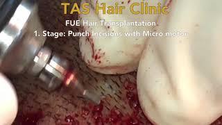 FUE Hair Transplantation - Stage 1