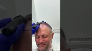 Hair Transplant in Turkey | Hair Transplant Process #hairtransplant