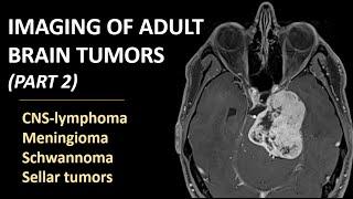 Imaging of brain tumors (part 2): CNS-lymphoma, meningioma, schwannoma and sellar tumors