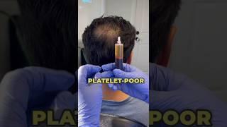 Thicker, fuller hair with PRP + microneedling!  Watch how we boost hair growth! #HairGoals #PRP