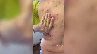 Popping huge blackheads and Giant Pimples - Best Pimple Popping Videos #156