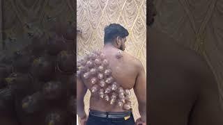 #cuppingtherapy #hijama #cupping #wetcupping #chennai #trending #shorts #shots #shortsvideo #short