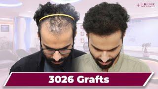 Hair Transplant Results: Full Journey & Before and After Photos