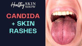 CANDIDA and Skin Rashes: A Hidden Root Cause | Jennifer Fugo