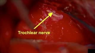 Gross Total Resection of Large CP Angle Meningioma with Suprameatal Drilling & Tentorial Sectioning