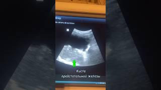 УЗИ предстательной железы на дому #узи #врач #уролог #здоровье #аденома #аденомапростаты #семья