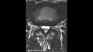 Adhesive Arachnoiditis: An Advanced Lecture