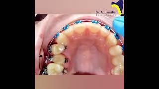 Best Ways to Make Space for Crooked Teeth Without Removing Any. #dentist #orthodontics  #braces