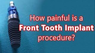 Front tooth implant procedure and how painful it is? - Dr. Muddugangadhar B C