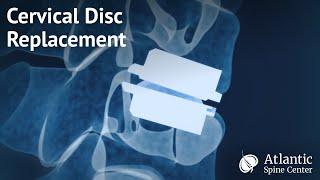 Cervical Disc Replacement