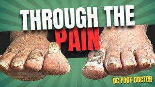 Through The Pain: Trimming Fungal Toenails