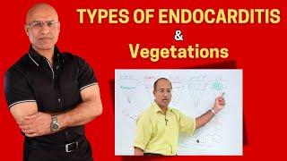 Endocarditis Types and Vegetations | Cardiology🫀