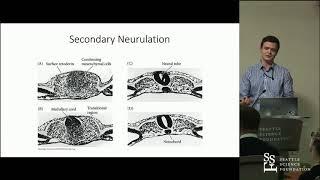 Junctional Neural Tube Defect in a Newborn - Cameron Schmidt