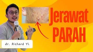 jerawat parah bisa sembuh | Dokter Richard YL