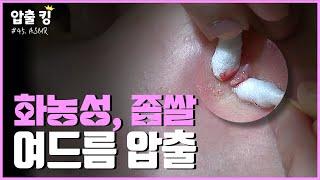 [압출킹] 45. 화농성, 좁쌀 여드름 압출 ASMR 시원함 주의!!!🫘