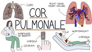 Cor Pulmonale | Drk