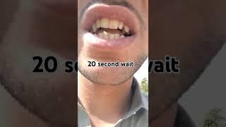 Ingrown teeth soft #ingrown_toenail_surgery #dentistteeth #funny #dentist #teethsmile #smile