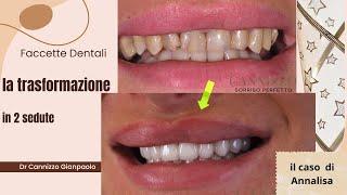 La trasformazione di un sorriso grazie alle faccette in ceramica - Studio Dentistico Cannizzo