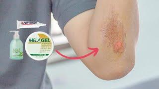 Healing Abrasions Effectively with Melaleuca Products