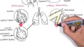 Chronic Obstructive Pulmonary Disease Overview (types, pathology, treatment)