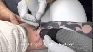 Laser tattoo removal virginia