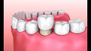 Восстановление зуба: пломба или коронка