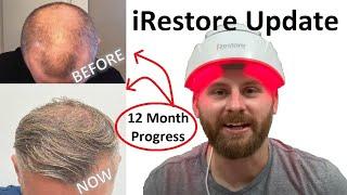 IRESTORE LASER HAIR GROWTH THERAPY 12 - MONTH UPDATE | Before and After Comparison