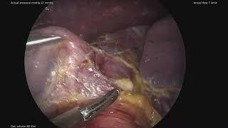 Nissen Fundoplication Operation