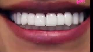 PERFECT SMILE VENEERS