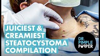 The JUICIEST & CREAMIEST Steatocystoma Compilation Ever!