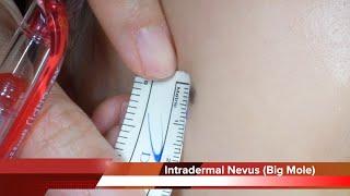 Intradermal Nevus on Cheek Removal Surgery (HD) 여성의 뺨에 큰 점 (진피내모반) 을 수술로 제거하는 방법 수원 광교 유디트성형외과 닥터랜사부