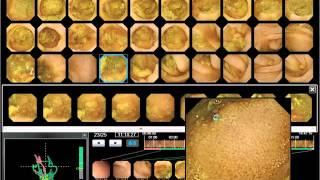 WEO Video Capsule Endoscopy (VCE) Library: clinical case 78