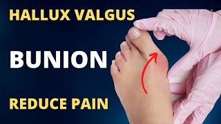 Hallux Valgus Treatment without Surgery