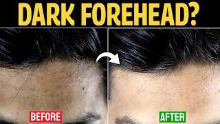 How To Get Rid of Dark Forehead: Proven Solution | Forehead Black Removal