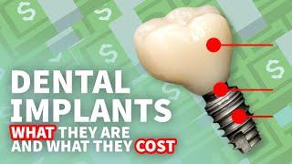  Dental Implants • What They Are and How Much Implants Cost 