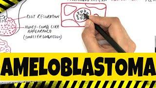 Ameloblastoma - Origination, Clinical, Radiographic & Histopathologic features