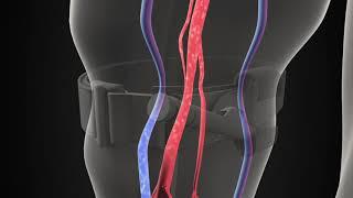 3D illustration of a tourniquet stopping blood flow