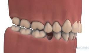 Conséquences de l'extraction - Centres dentaires Lapointe