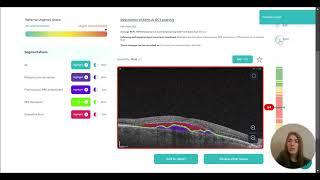 AI detects Wet AMD on OCT scan