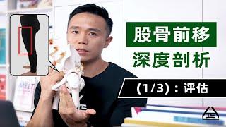 【股骨前移】深度剖析(1/3)：评估。大腿前侧凸出？先看下是否股骨前移