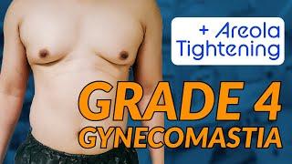 Transforming Grade 4 Gynecomastia: Full Surgery Breakdown with VASER & Gland Excision