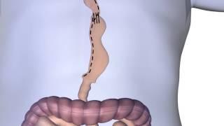 Esophagectomy Procedure Animation
