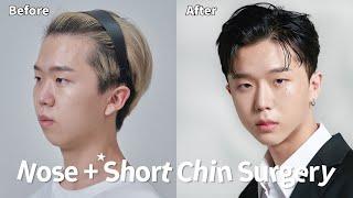 Male Rhinoplasty and Short Chin Correction with Implant at Girin Plastic Surgery Korea