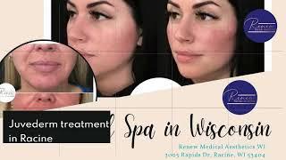 Juvederm by Renew Medical Aesthetics WI in Racine, WI 53404, 414 310 6541