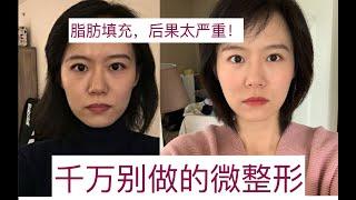 【险些毁容】最后怕的微整形项目是什么？年轻不懂事，变美的代价太大。大家千万不要做！