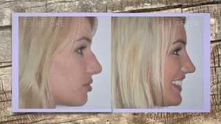 Dr William Mooney Rhinoplasty Nose Job Before After Gallery 2013