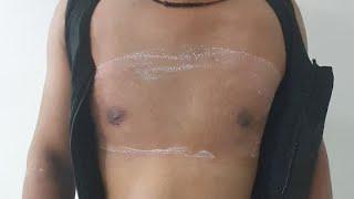 Gynecomastia 1st Post Op Day by Dr. AMit Gupta - Divine Cosmetic Surgery - April 2021