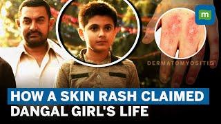 Dangal Actress Suhani Bhatnagar Death: What Is Rare Skin Infection Dermatomyositis? | Explained